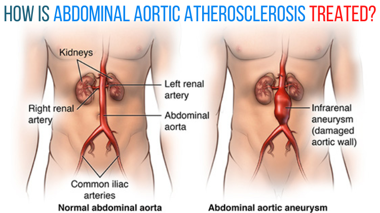 Abdominal Aortic Atherosclerosis Treatment