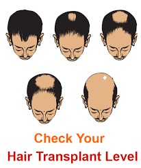 HAIR TRANSPLANT IN dELHI