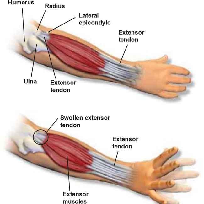 Golfers elbow treatment surrey