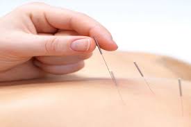 dry needling physio in abbotsford